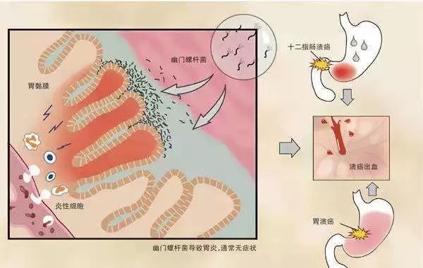 不爱用公筷，一半中国人都感染了这种致癌菌！