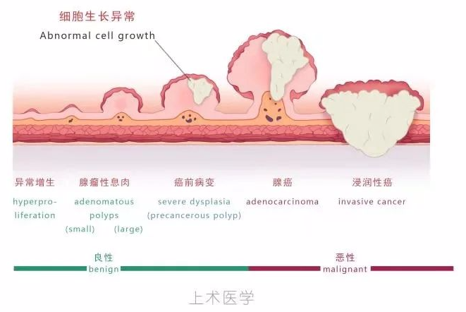 肠息肉原因图片