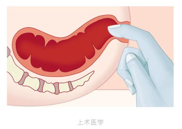 胃肠道早癌——这4个检查就能轻易发现！