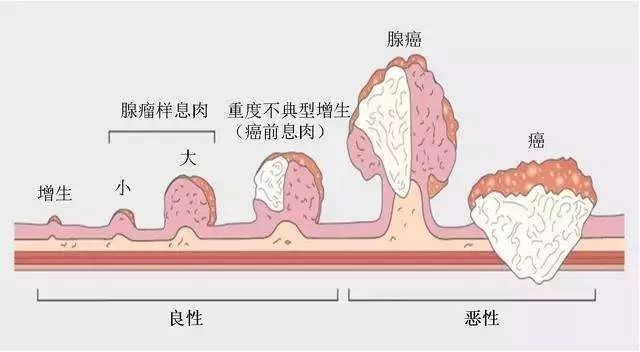 【科普】结直肠癌喜好这群人，你中招了吗？