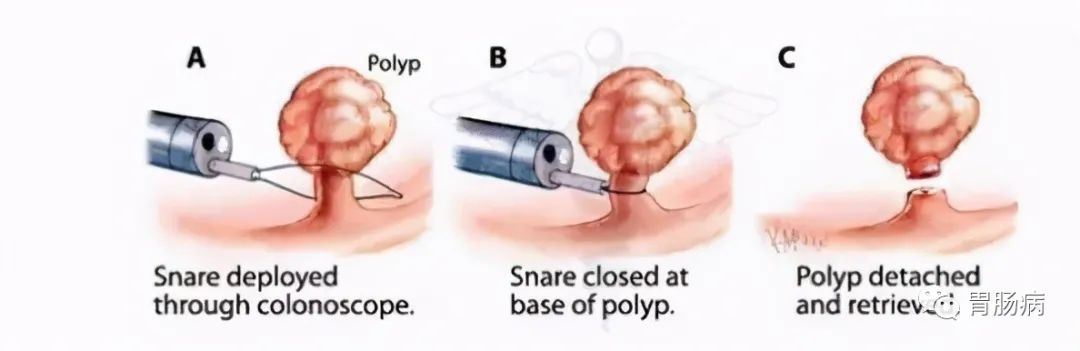 肠镜检查全科普——你想知道的，都在这里