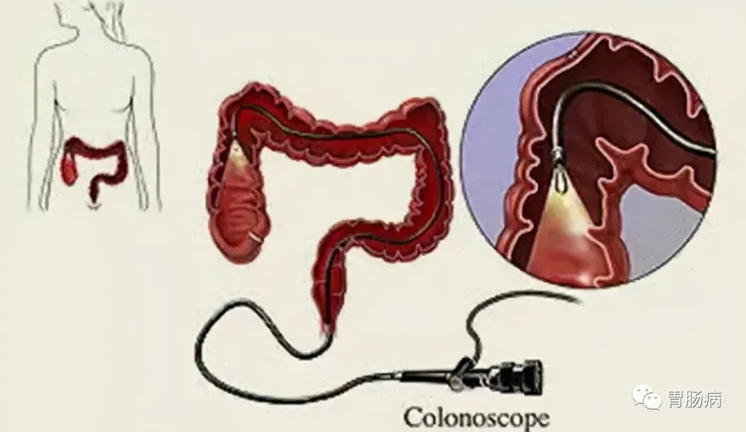 肠镜检查全科普——你想知道的，都在这里