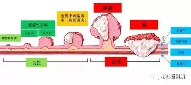 兄妹俩都有息肉：哥哥检查早，没事；妹妹检查晚，进展期癌