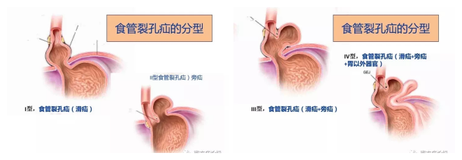 一咳嗽就尿裤子，想不到竟是这种病