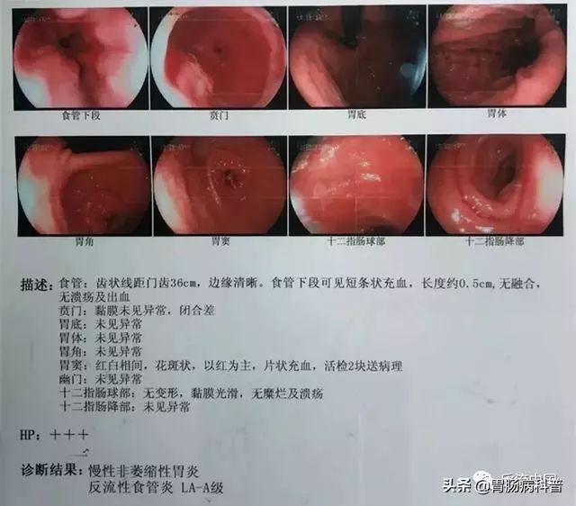 一咳嗽就尿裤子，想不到竟是这种病