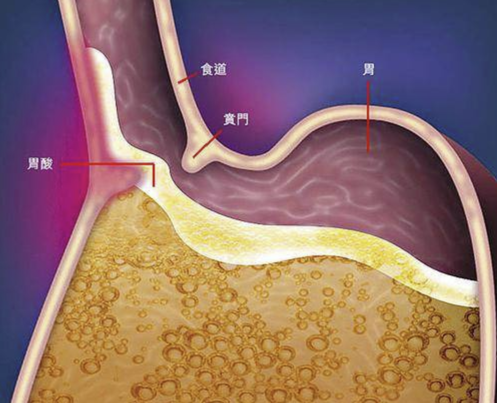 胃一直胀气，胃镜检查结果是胆汁返流该怎么办？