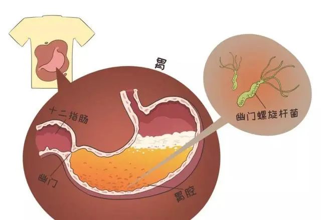 胃息肉，到底要不要斩草除根？为什么会出现胃息肉？