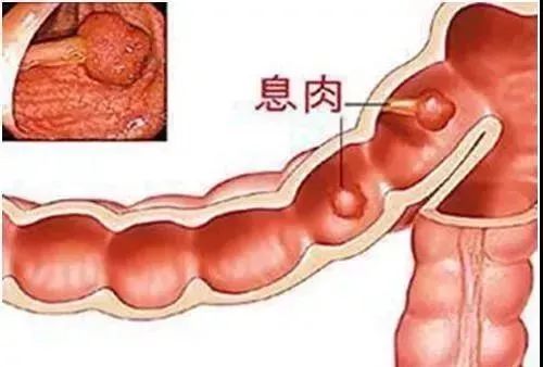 胃肠息肉切除后一定要记得及时复查