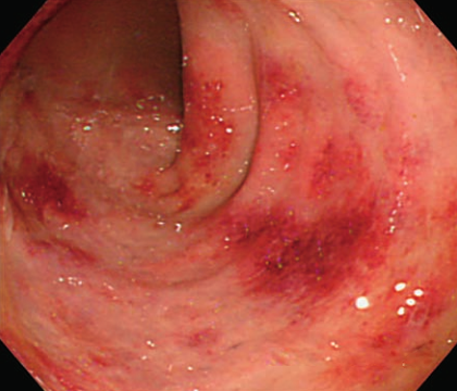 十二指肠溃疡胃镜图片图片