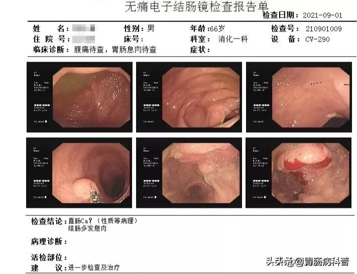 这种高发癌症，只要在40岁前做一次检查，就能避免