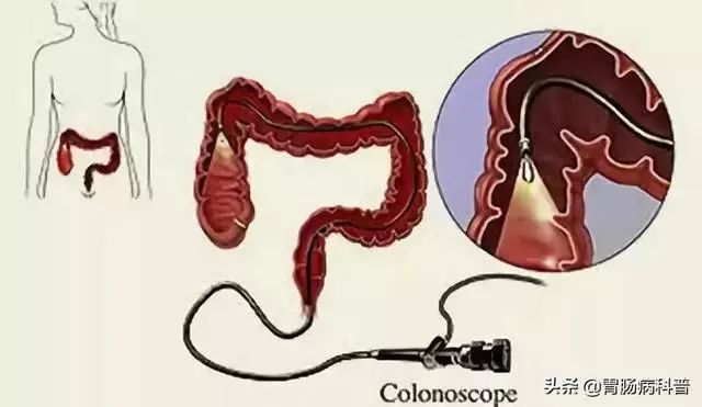 建议：这些人做个肠镜，安安心心双节