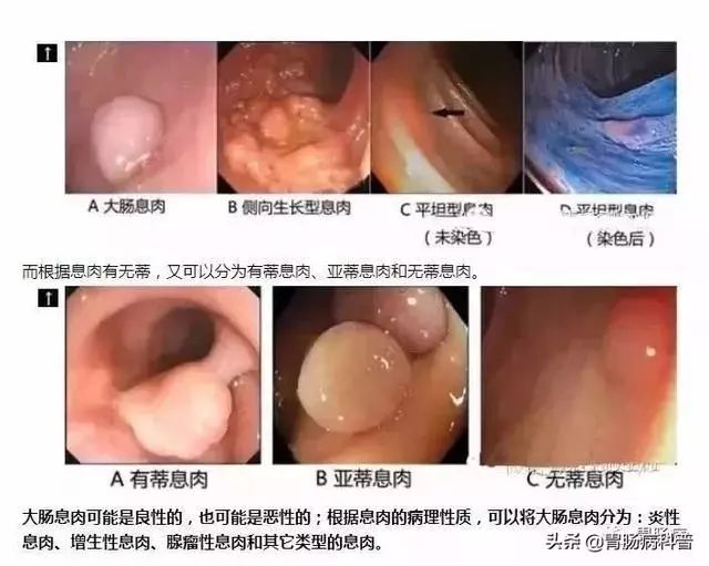 不是说一次肠镜能保10年没事吗？我怎么5年就癌变了？