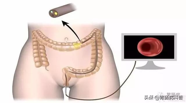 不是说一次肠镜能保10年没事吗？我怎么5年就癌变了？