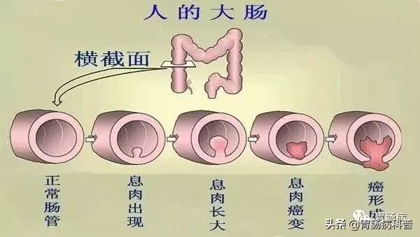 不是说一次肠镜能保10年没事吗？我怎么5年就癌变了？