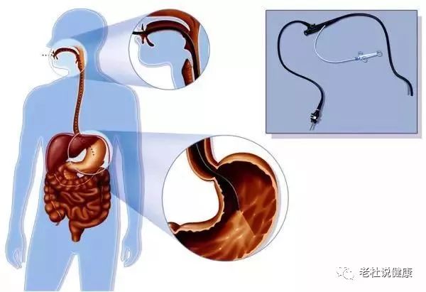 70%的早期胃癌没信号——要想早发现，得靠这一招
