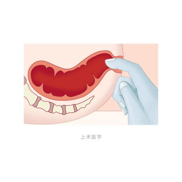 胃肠道早癌——这4个检查就能轻易发现！