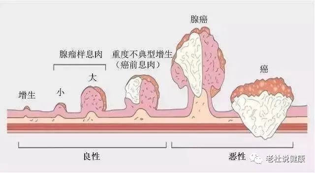 一枚小息肉，“养”在肠道20年，会变什么样？