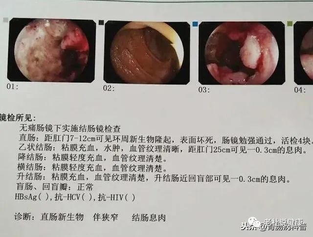 假如我没有坚持，这个肠癌就可能漏诊了！——便血，可别轻易当痔疮