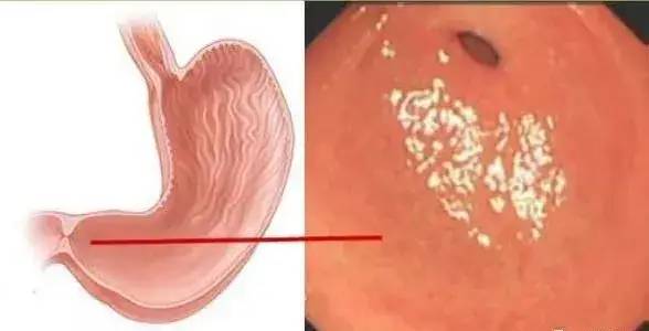 胃镜不只是检查“胃”：一组图片告诉你胃镜多厉害！
