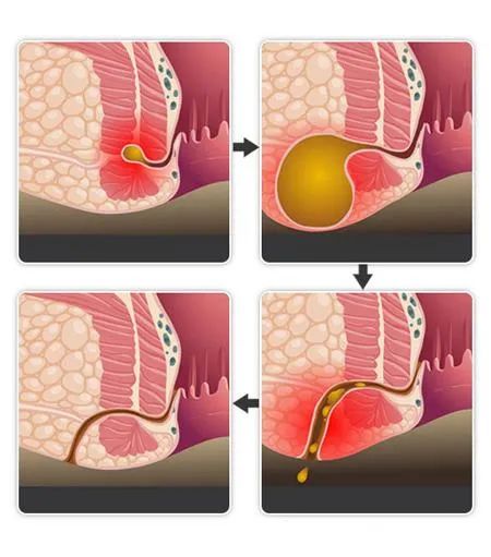 肛瘘是怎么回事？不管不顾可不行！