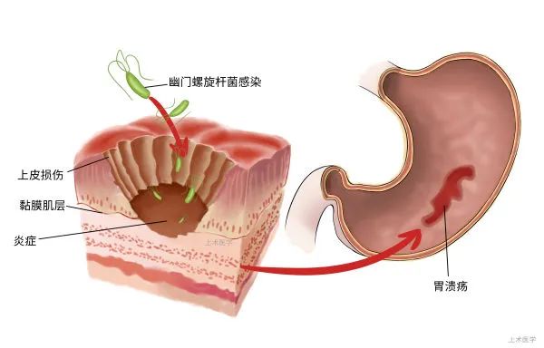 它是长在胃里的Ⅰ类致癌因子！四种行为让你“吃”下它，老人和孩子易感~