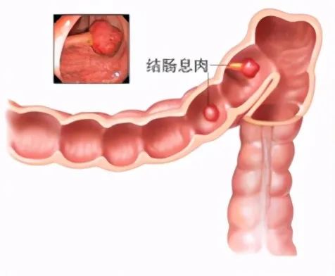 直肠息肉是直肠癌的前身？怎么判断自己有没有？