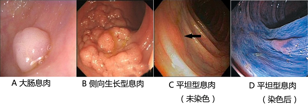 直肠息肉是直肠癌的前身？怎么判断自己有没有？