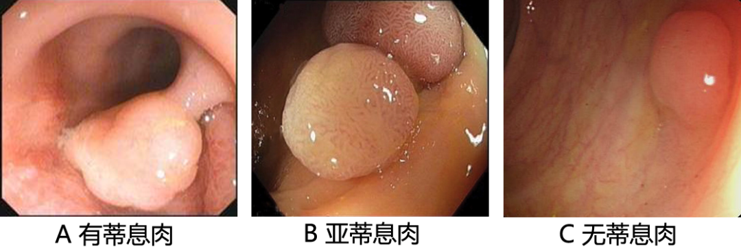 直肠息肉是直肠癌的前身？怎么判断自己有没有？