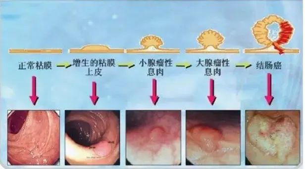 直肠息肉是直肠癌的前身？怎么判断自己有没有？