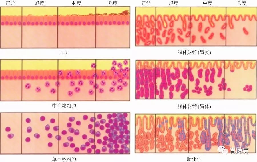 提醒：这6种情况，是胃癌的癌前疾病/癌前病变