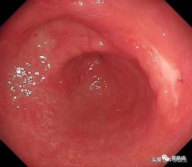 到底是胃癌，还是胃溃疡？