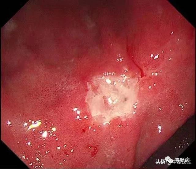 到底是胃癌，还是胃溃疡？