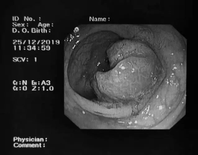 又有一例！36岁男子，便血一年当痔疮，确诊直肠癌