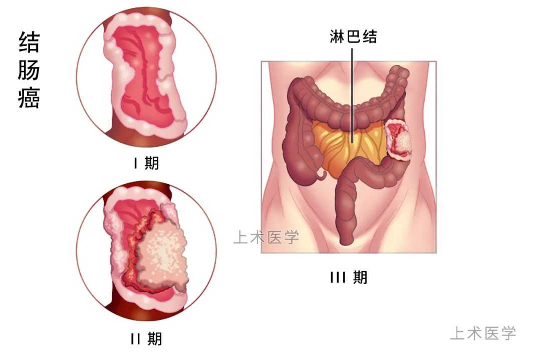 从息肉到大肠癌，仅仅是一次肠镜的距离！