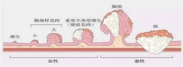 肠息肉6年变成癌！医生提醒：肠镜要做，息肉要切