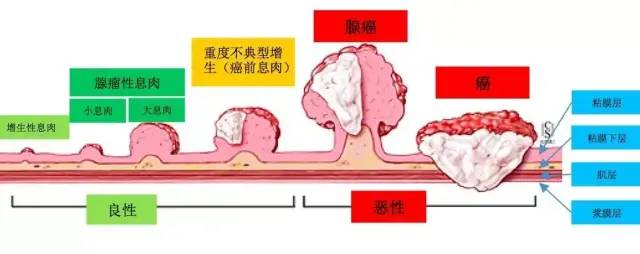 夫妻双双查出肠癌：癌症也会“夫唱妇随”？