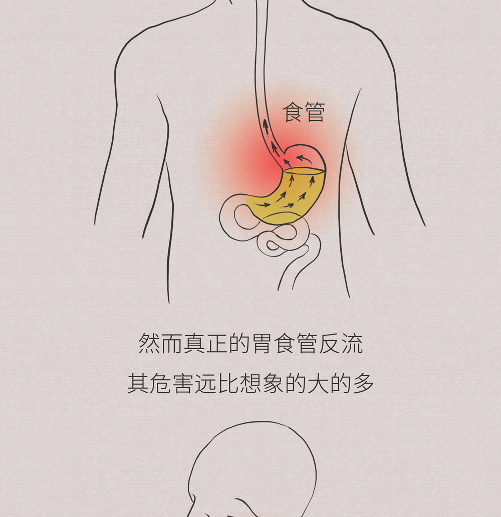 烧心反酸，这种疾病可不是你想的那么简单！