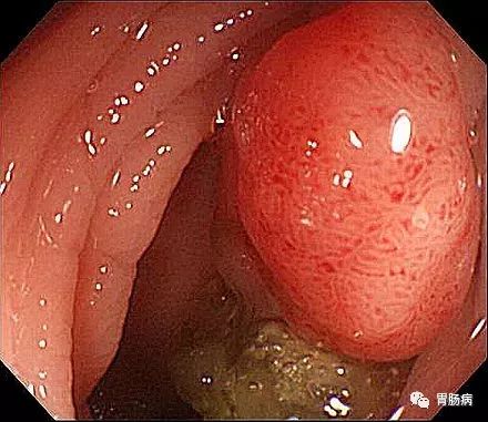 消化科医生提醒：这样的大便，可能预示着大肠癌上身！