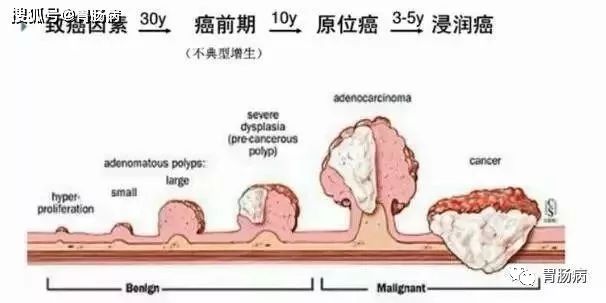 消化科医生提醒：这样的大便，可能预示着大肠癌上身！