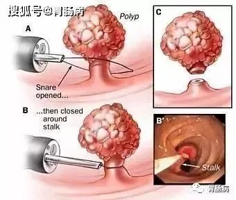 消化科医生提醒：这样的大便，可能预示着大肠癌上身！