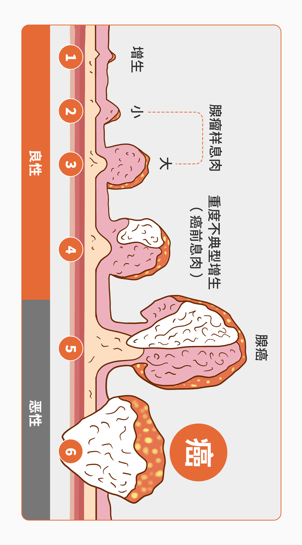 肠道内藏着个定时炸弹，尤其40岁以上的爷们，要格外注意了