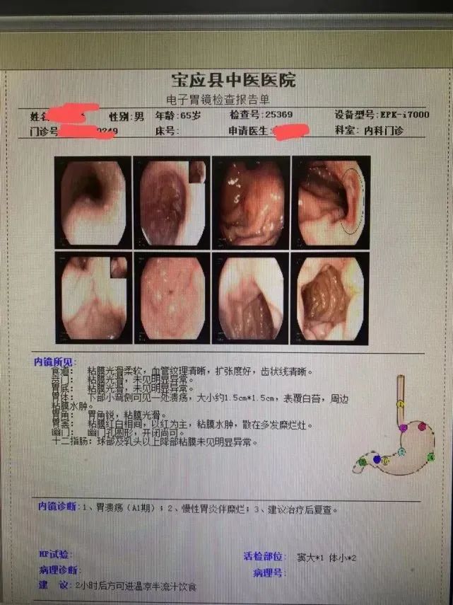 得了胃溃疡，反复发作怎么办？这几点你应该知道