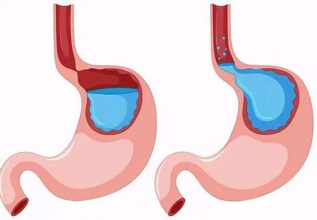 善于伪装的胃食管反流病，70多种病与它相关