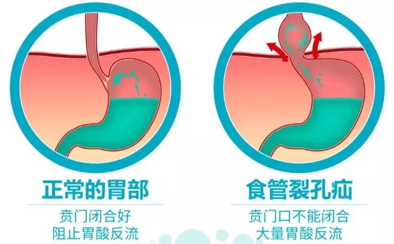 频繁打嗝，为你揭秘其中缘由