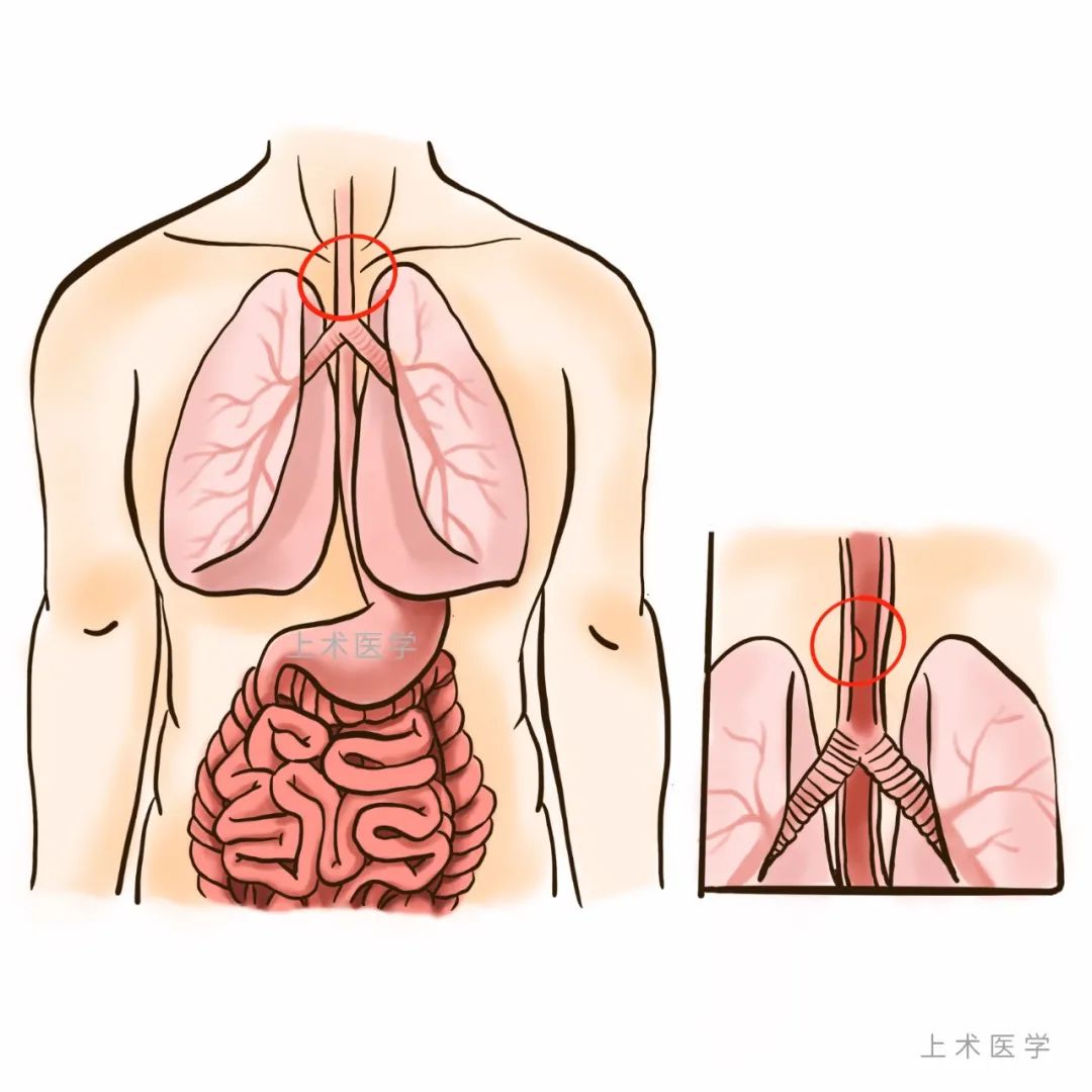 到底多烫的食物会导致食管癌？请收好这份食管癌筛查和预防攻略！