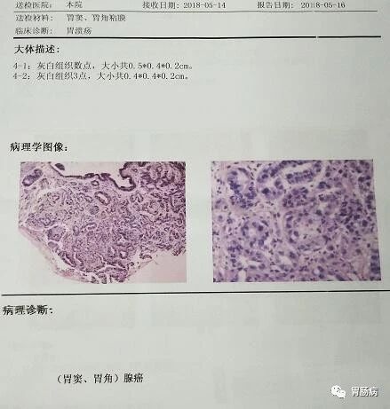 男子左上腹疼，诊断“带状疱疹”；幕后真凶让人不寒而栗