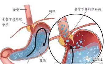 诱发胃食管反流病的9大因素