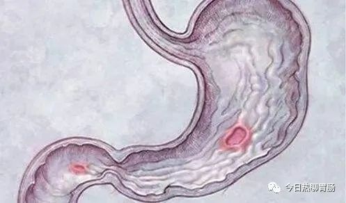 出现黑便、厌食、消瘦、胃痛加重，要警惕“胃溃疡”并发症