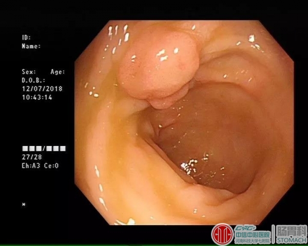 明明是良性的肠息肉，怎么说癌变就癌变了？！