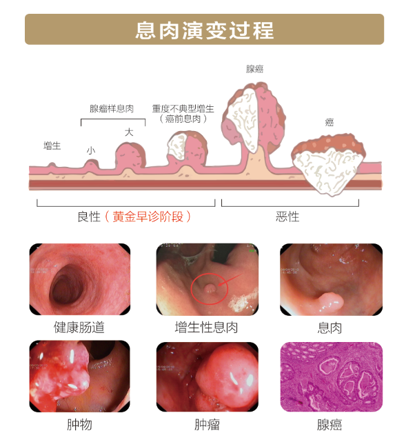 排便出现这四大症状，年过40岁千万要注意！